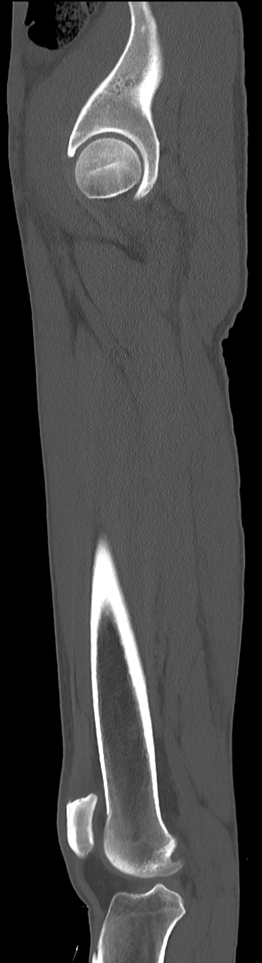 Chronic osteomyelitis (with sequestrum) (Radiopaedia 74813-85822 C 32).jpg