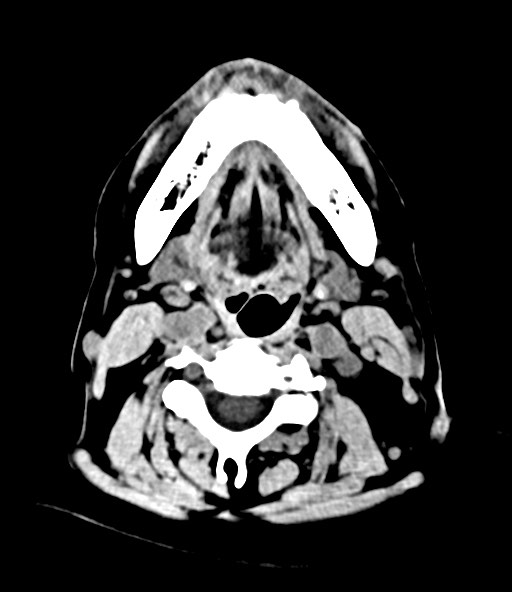 File:Chronic osteomyelitis - calvarial (severe) (Radiopaedia 69668-79616 Axial non-contrast 4).jpg