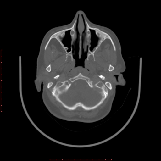File:Chronic osteomyelitis - maxilla (Radiopaedia 23783-23927 Axial bone window 112).jpg