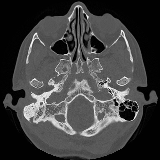 File:Chronic otomastoiditis (Radiopaedia 27138-27309 Axial bone window 10).jpg