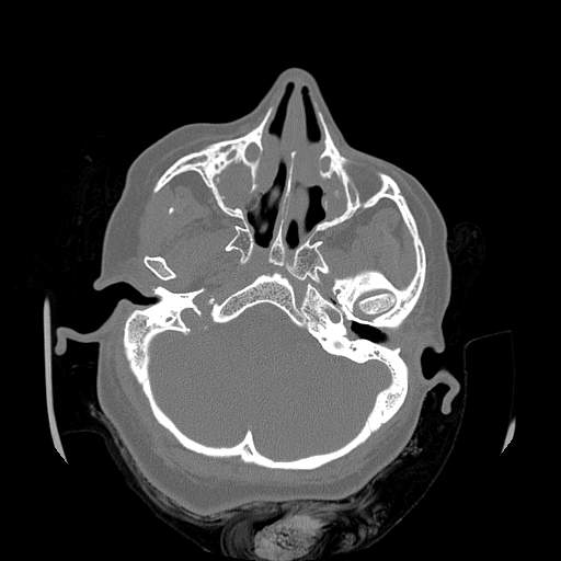 Chronic sinusitis with intra-sinus calcification (Radiopaedia 63919-72668 Axial bone window 46).jpg