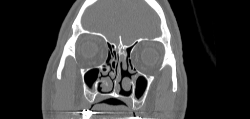 Chronic sphenoidal sinusitis (Radiopaedia 62030-70122 Coronal bone window 55).jpg