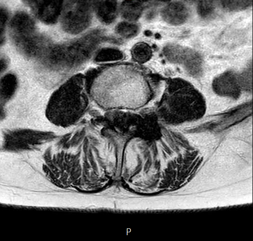 File:Chronic spinal hematoma with cauda equina syndrome (Radiopaedia 75745-87090 Axial T2 11).png