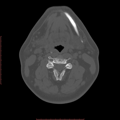 File:Chronic submandibular sialolithiasis (Radiopaedia 69817-79814 Axial bone window 84).jpg