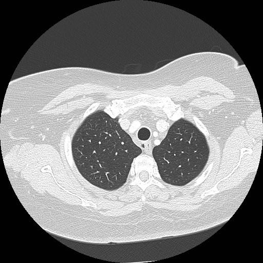 File:Cicatrisation collapse (Radiopaedia 17405-17089 lung window 20).jpg