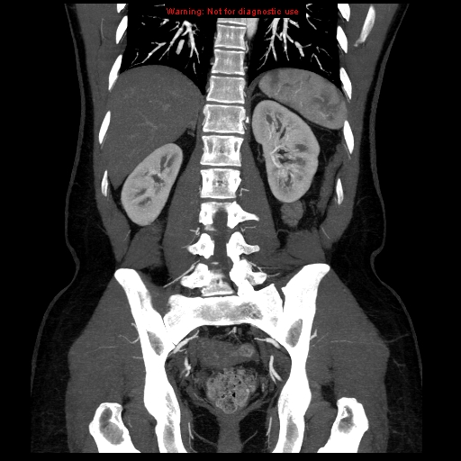 File:Circumaortic left renal vein (Radiopaedia 9069-9792 B 30).jpg