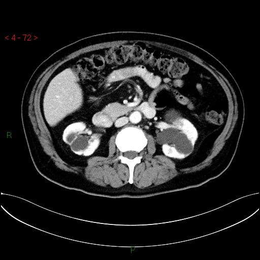 File:Circumaortic left renal vein and doubled left renal arteries (Radiopaedia 52268-58158 B 32).jpg