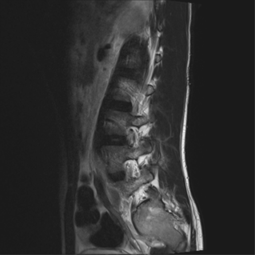 File:Clear cell meningoma - lumbar spine (Radiopaedia 60116-67690 Sagittal T2 3).png