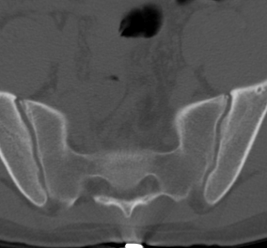 Clear cell meningoma - lumbar spine (Radiopaedia 60116-67691 Axial bone window 77).png