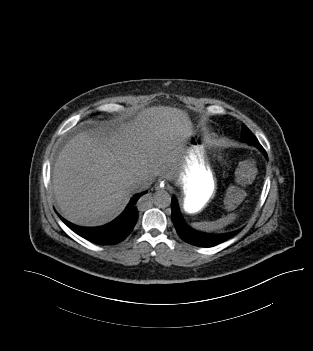 Closed-loop small bowel obstruction-internal hernia (Radiopaedia 78439-91096 Axial non-contrast 23).jpg