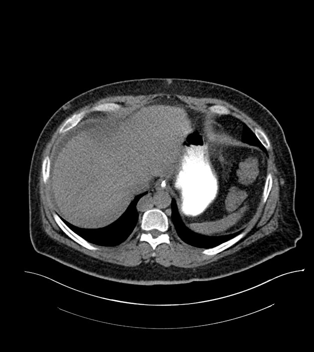 Closed-loop small bowel obstruction-internal hernia (Radiopaedia 78439-91096 Axial non-contrast 24).jpg