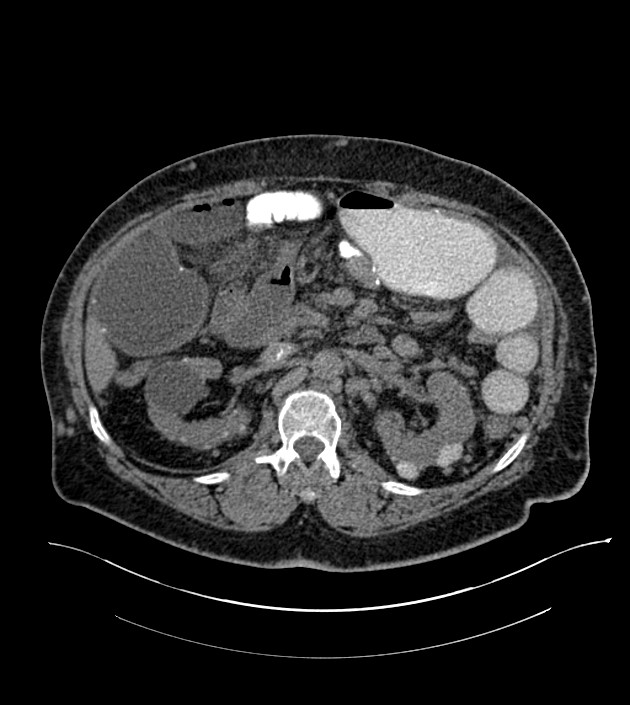 Closed-loop small bowel obstruction-internal hernia (Radiopaedia 78439-91096 Axial non-contrast 61).jpg