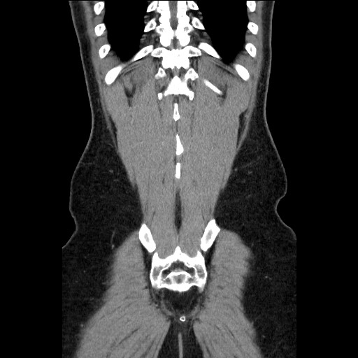 Closed-loop small bowel obstruction (Radiopaedia 73713-84509 C 110).jpg