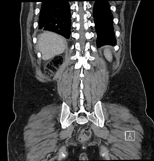 File:Closed loop obstruction - internal hernia into nephrectomy bed (Radiopaedia 59867-67320 B 118).jpg