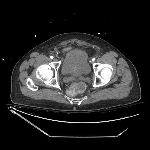 File:Closed loop obstruction due to adhesive band, resulting in small bowel ischemia and resection (Radiopaedia 83835-99023 B 142).jpg
