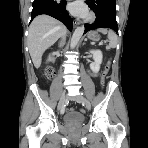 File:Closed loop small bowel obstruction (Radiopaedia 59227-66554 B 29).jpg