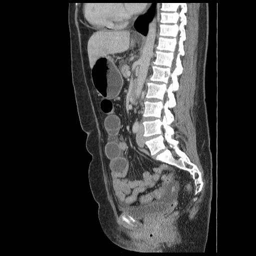 Closed loop small bowel obstruction (Radiopaedia 65403-74451 C 51).jpg