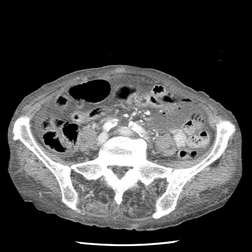 File:Closed loop small bowel obstruction - adhesions and infarct (Radiopaedia 85125-100678 B 63).jpg