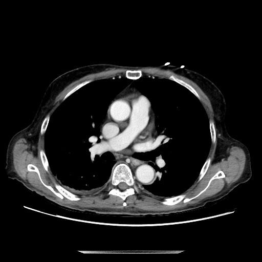 File:Closed loop small bowel obstruction - adhesive disease and hemorrhagic ischemia (Radiopaedia 86831-102990 A 1).jpg