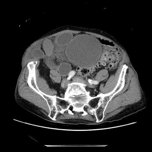File:Closed loop small bowel obstruction - adhesive disease and hemorrhagic ischemia (Radiopaedia 86831-102990 A 135).jpg