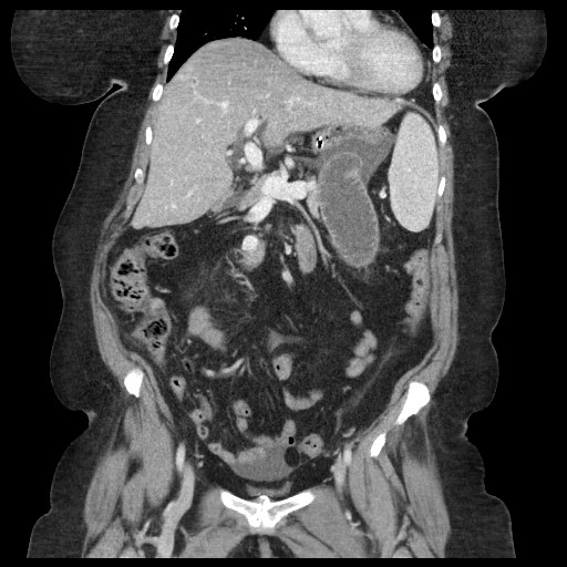 Closed loop small bowel obstruction - internal hernia (Radiopaedia 65402-74450 B 47).jpg