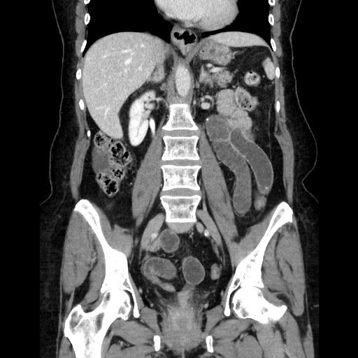 Closed loop small bowel obstruction due to adhesive bands - early and late images (Radiopaedia 83830-99015 B 71).jpg