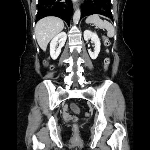 File:Closed loop small bowel obstruction due to adhesive bands - early and late images (Radiopaedia 83830-99015 B 84).jpg