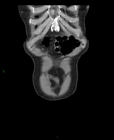 File:Closed loop small bowel obstruction with ischemia (Radiopaedia 84180-99456 B 63).jpg