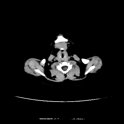 Cloverleaf skull (Radiopaedia 91901-109710 Axial non-contrast 14).jpg