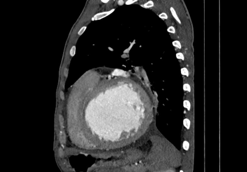 Coarctation of aorta with aortic valve stenosis (Radiopaedia 70463-80574 B 138).jpg