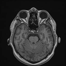 File:Cochlear incomplete partition type III associated with hypothalamic hamartoma (Radiopaedia 88756-105498 Axial T1 76).jpg