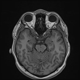 File:Cochlear incomplete partition type III associated with hypothalamic hamartoma (Radiopaedia 88756-105498 Axial T1 81).jpg