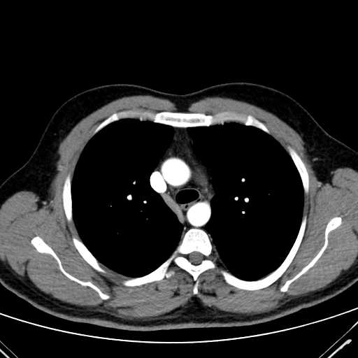 Codominant double aortic arch (Radiopaedia 56012-62637 A 22).jpg