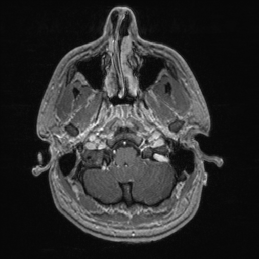 File:Colloid cyst (Radiopaedia 44510-48181 Axial T1 C+ 35).png