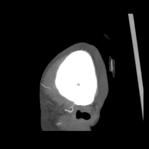 File:Colloid cyst (resulting in death) (Radiopaedia 33423-34499 B 1).png