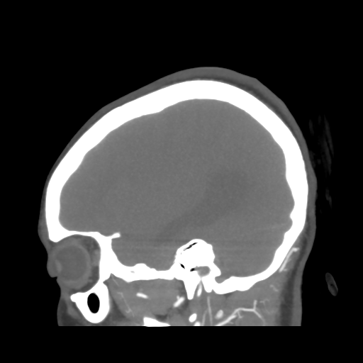 File:Colloid cyst (resulting in death) (Radiopaedia 33423-34499 B 43).png