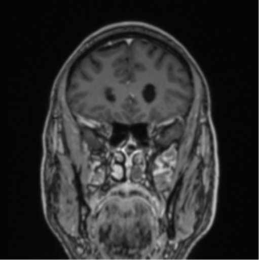 File:Colloid cyst of the third ventricle (Radiopaedia 86571-102662 Coronal T1 C+ 68).png