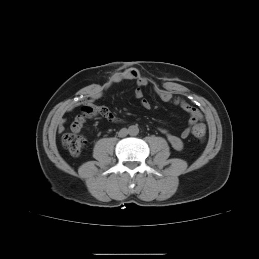 File:Colocutaneous fistula in Crohn's disease (Radiopaedia 29586-30093 Axial non-contrast 10).jpg