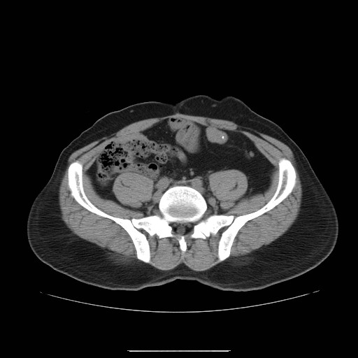File:Colocutaneous fistula in Crohn's disease (Radiopaedia 29586-30093 Axial non-contrast 24).jpg