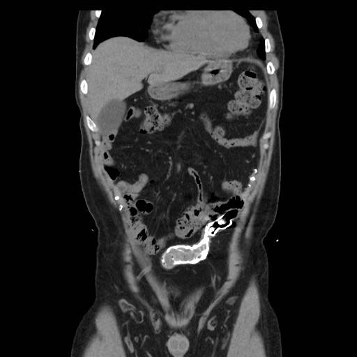 File:Colocutaneous fistula in Crohn's disease (Radiopaedia 29586-30093 E 1).jpg