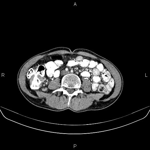 Colon adenocarcinoma - hepatic flexure (Radiopaedia 85635-101395 A 53).jpg