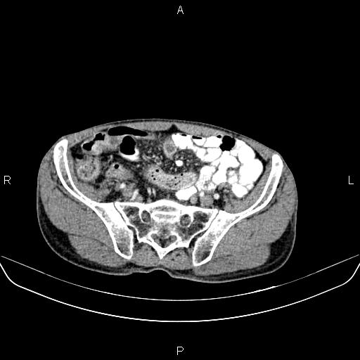 File:Colon adenocarcinoma - hepatic flexure (Radiopaedia 85635-101395 A 72).jpg