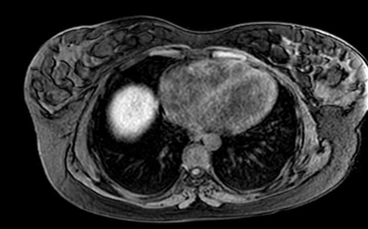 File:Colon adenocarcinoma with Krukenberg tumors, advanced pregnancy (Radiopaedia 67279-76645 A 80).jpg