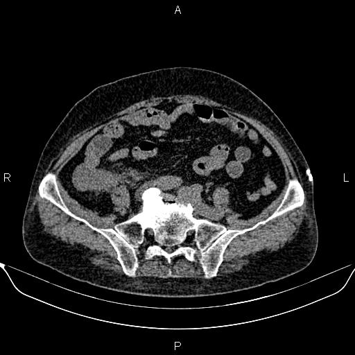 File:Colon cancer (Radiopaedia 90215-107432 Axial non-contrast 65).jpg