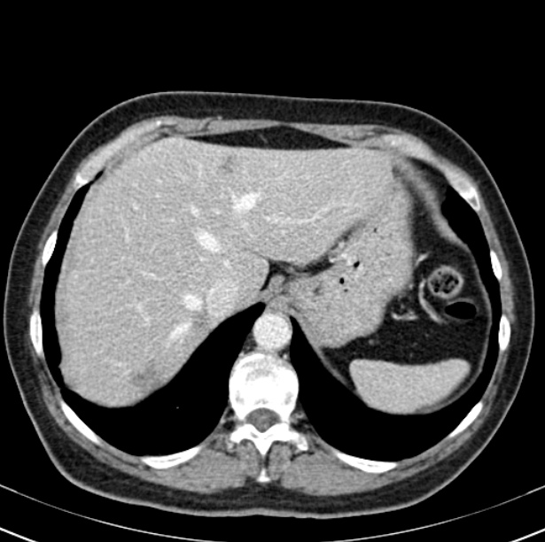 Colon carcinoma with hepatic metastases (Radiopaedia 29477-29961 A 18).jpg