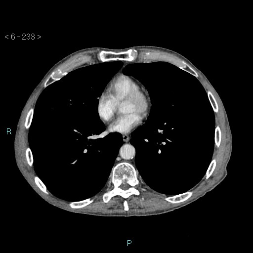 File:Colonic cancer (ultrasound and TC imaging) (Radiopaedia 50346-55713 B 233).jpg