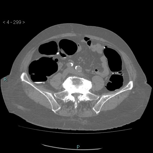 Colonic lipomas (Radiopaedia 49137-54244 Axial bone window 133).jpg