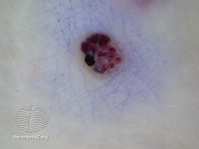 File:Dermoscopy of angiokeratoma of Fordyce on vulva (DermNet NZ angiokeratoma-43).jpg