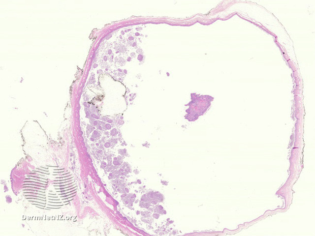 File:Figure 1 (DermNet NZ pathology-e-bronchogenic-cyst-figure-1).jpg