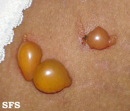 File:Impetigo (Dermatology Atlas 21).jpg